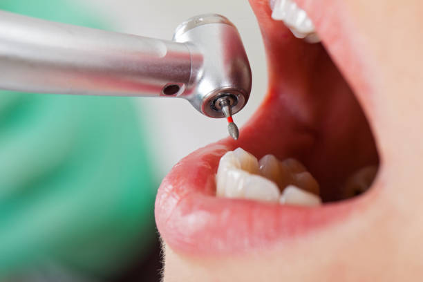 Best Chipped Tooth Repair Near Me  in Gordon, NE